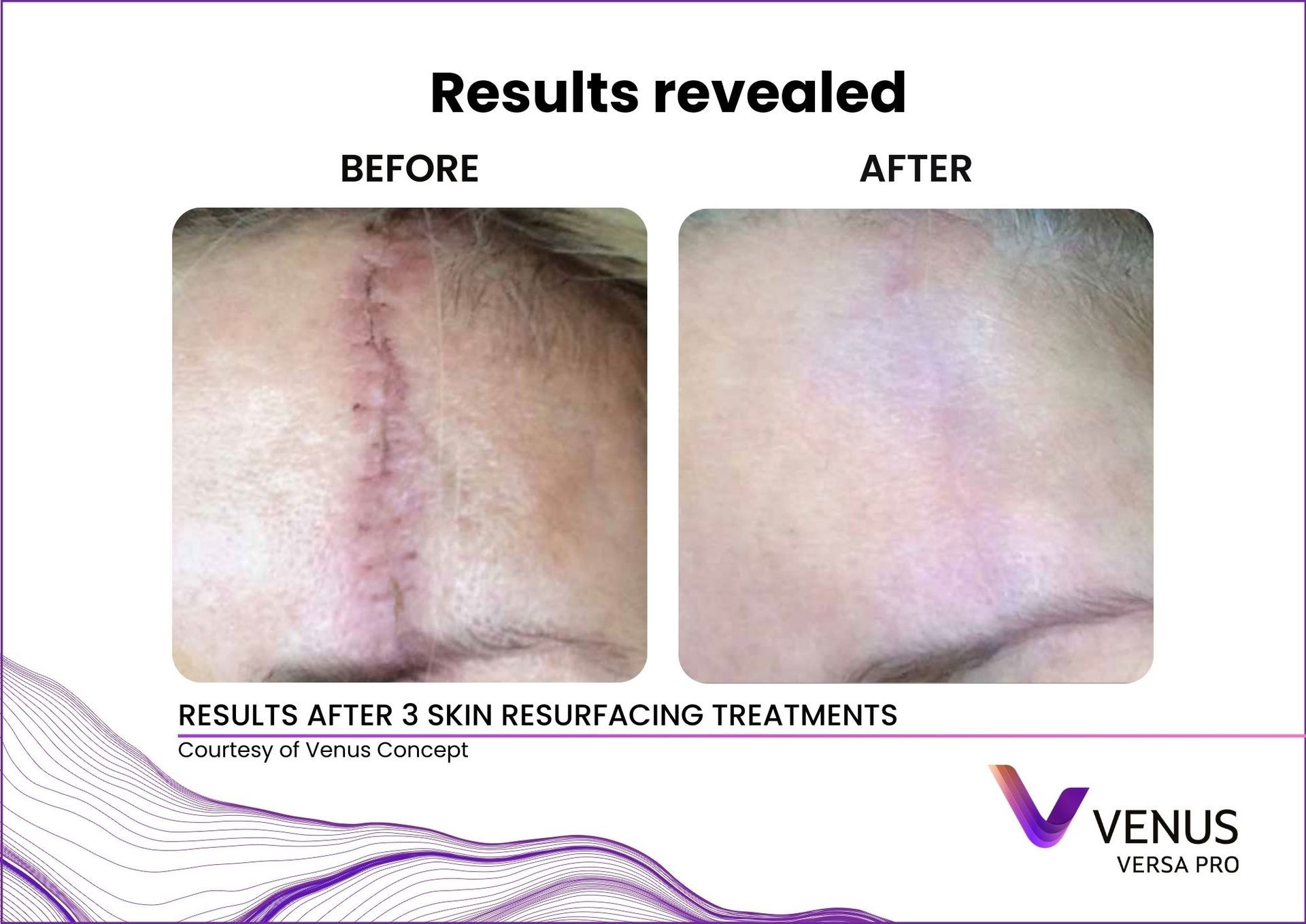 Skin Resurfacing Treatment