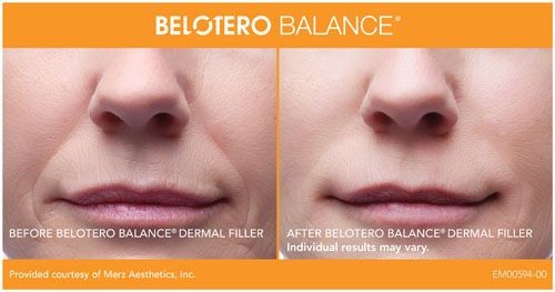 Belotero (Dermal Filler)